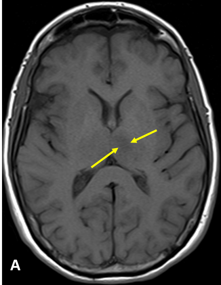 Acute Infarct - MRI Online / Medality