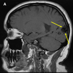 Avm Rash Arteriovenous Malformation (AVM) - MRI Online / Medality