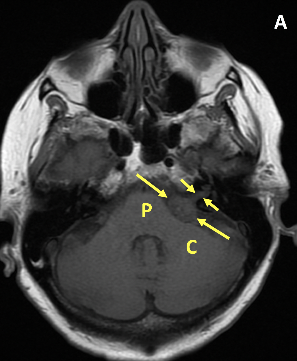 Vestibular Schwannoma MRI Online Medality Vestibular Schwannoma MRI Online Medality