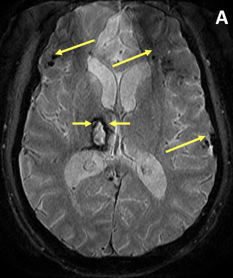 Diffuse Axonal Injury (DAI) - MRI Online / Medality