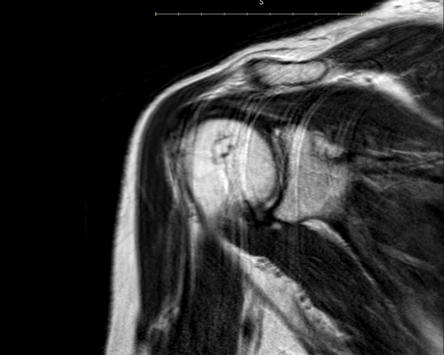 upper-extrem-1