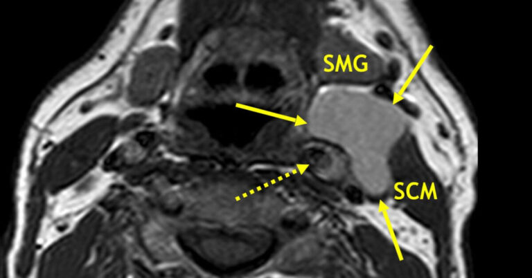 What Is a Branchial Cleft Cyst?